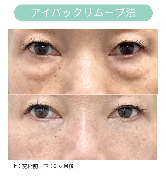＼切開法クマ治療／アイバックリムーブ