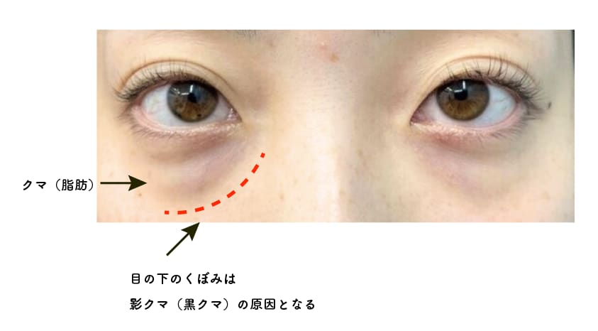 こだわりを持って行われる脂肪注入