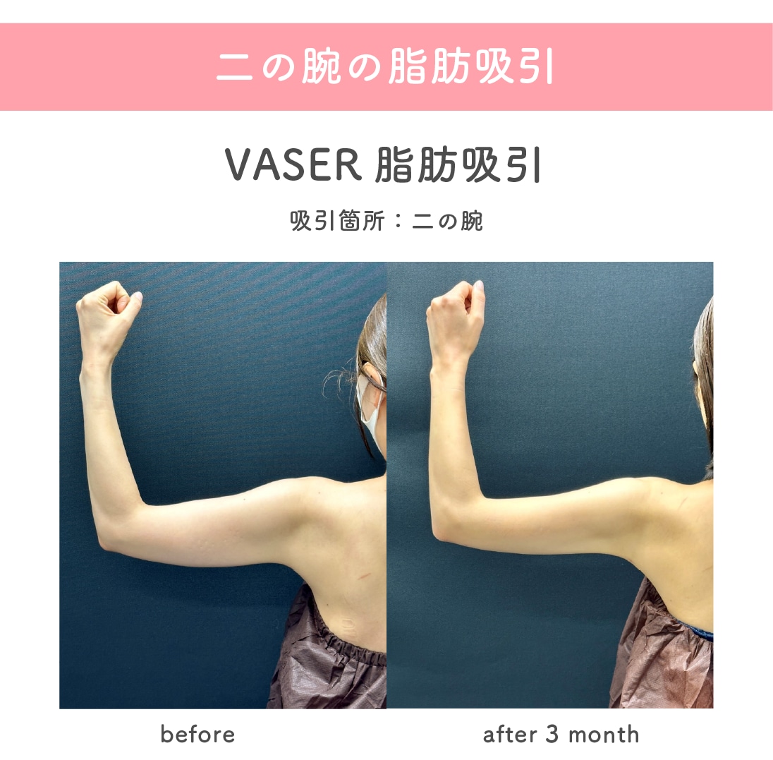 二の腕の脂肪吸引