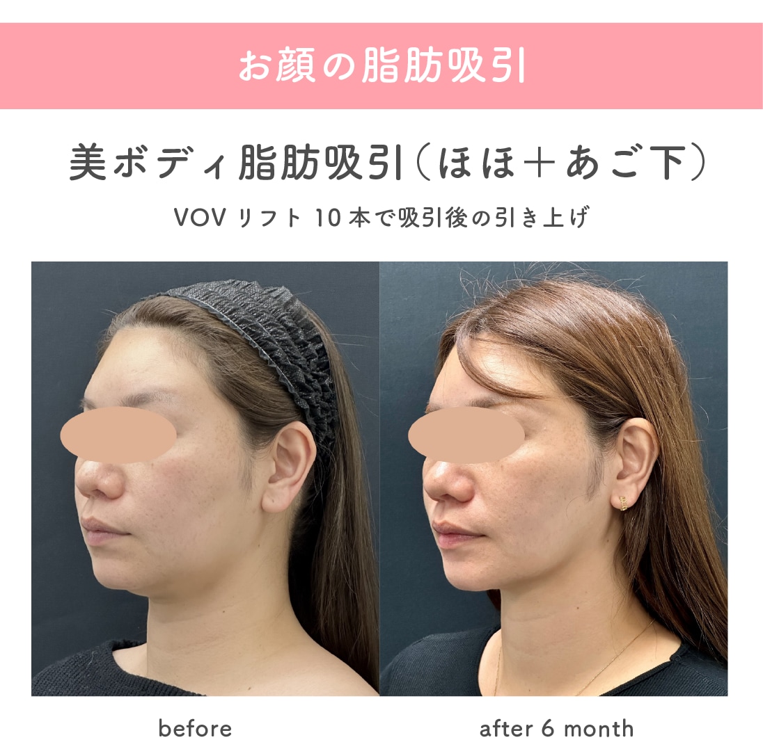 顔の脂肪吸引