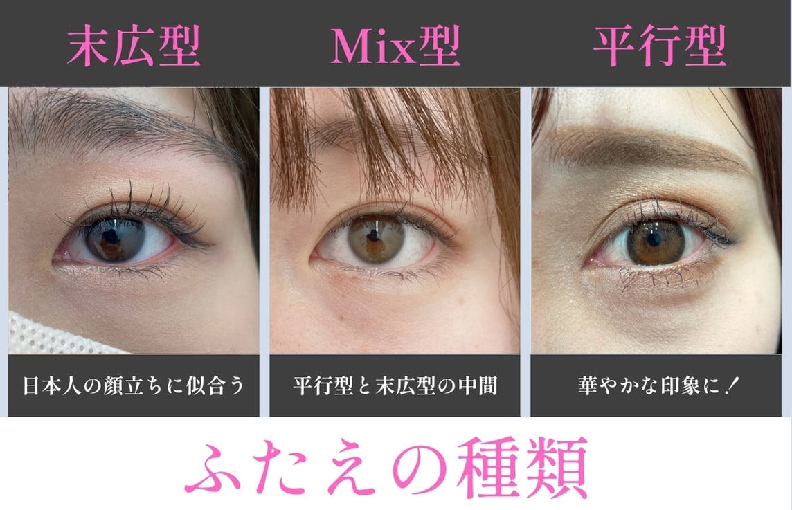 症例あり】二重まぶたの種類を徹底解説 - 福山院