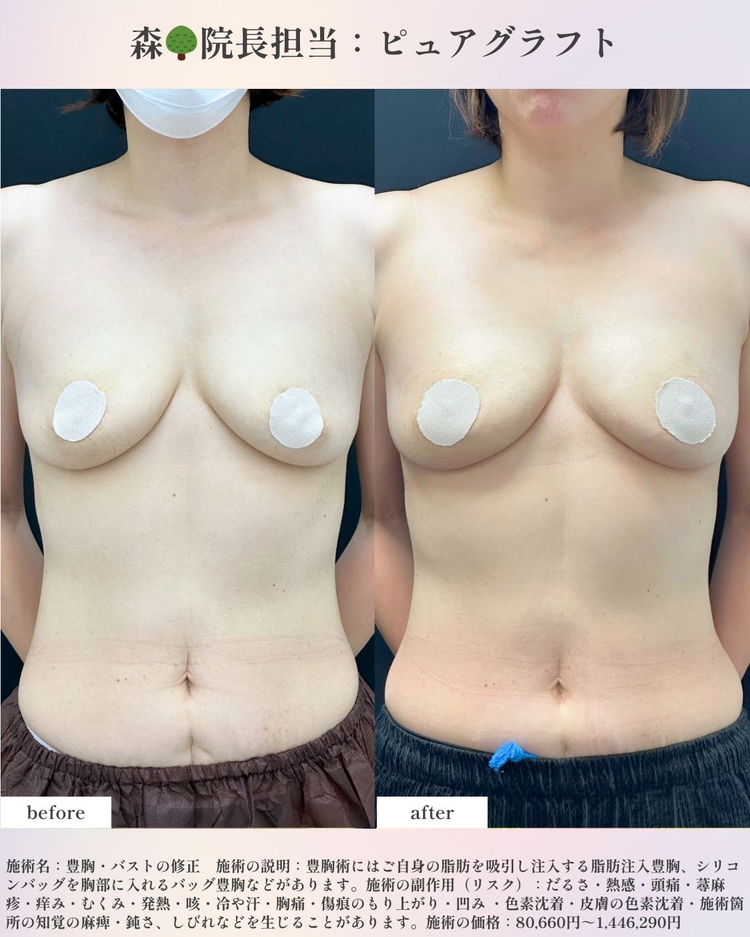 【40代女性】（脂肪注入豊胸）