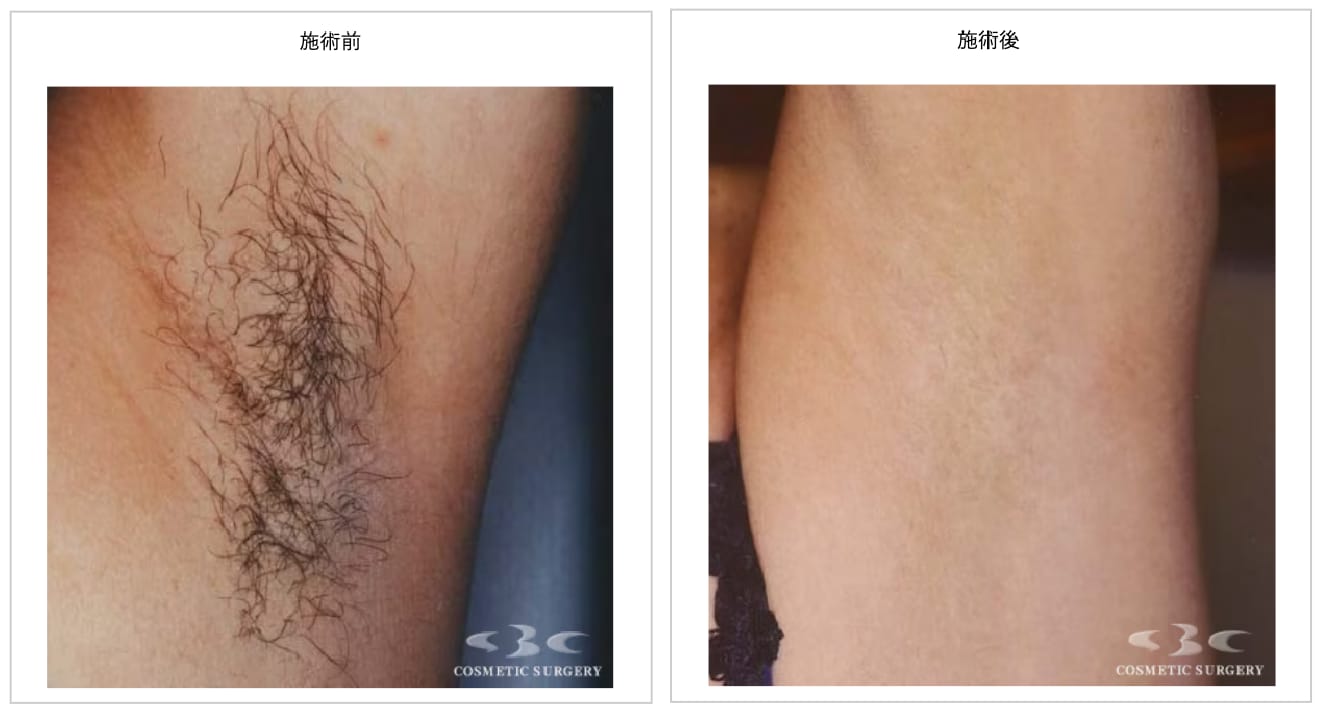 実際にSBCで脱毛を受けたお客様のお写真をご紹介♪