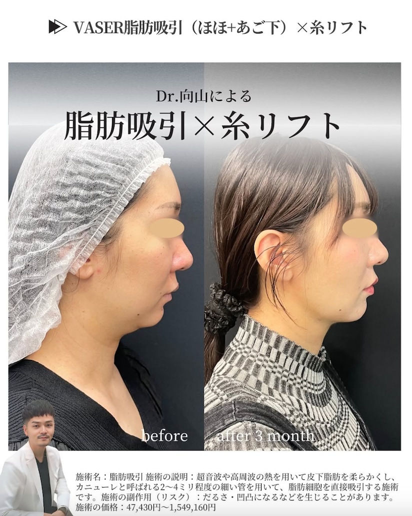 脂肪吸引による小顔術