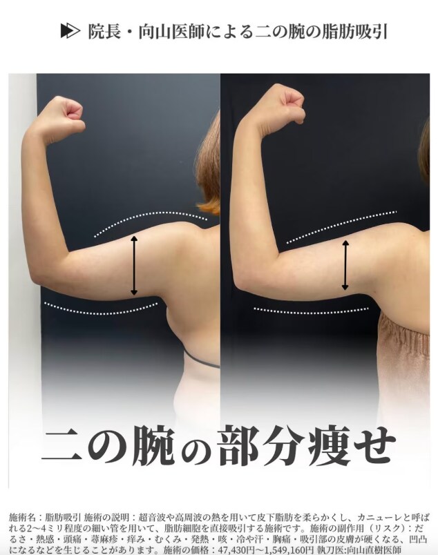 二の腕スッキリ✨圧倒的な部分痩せ