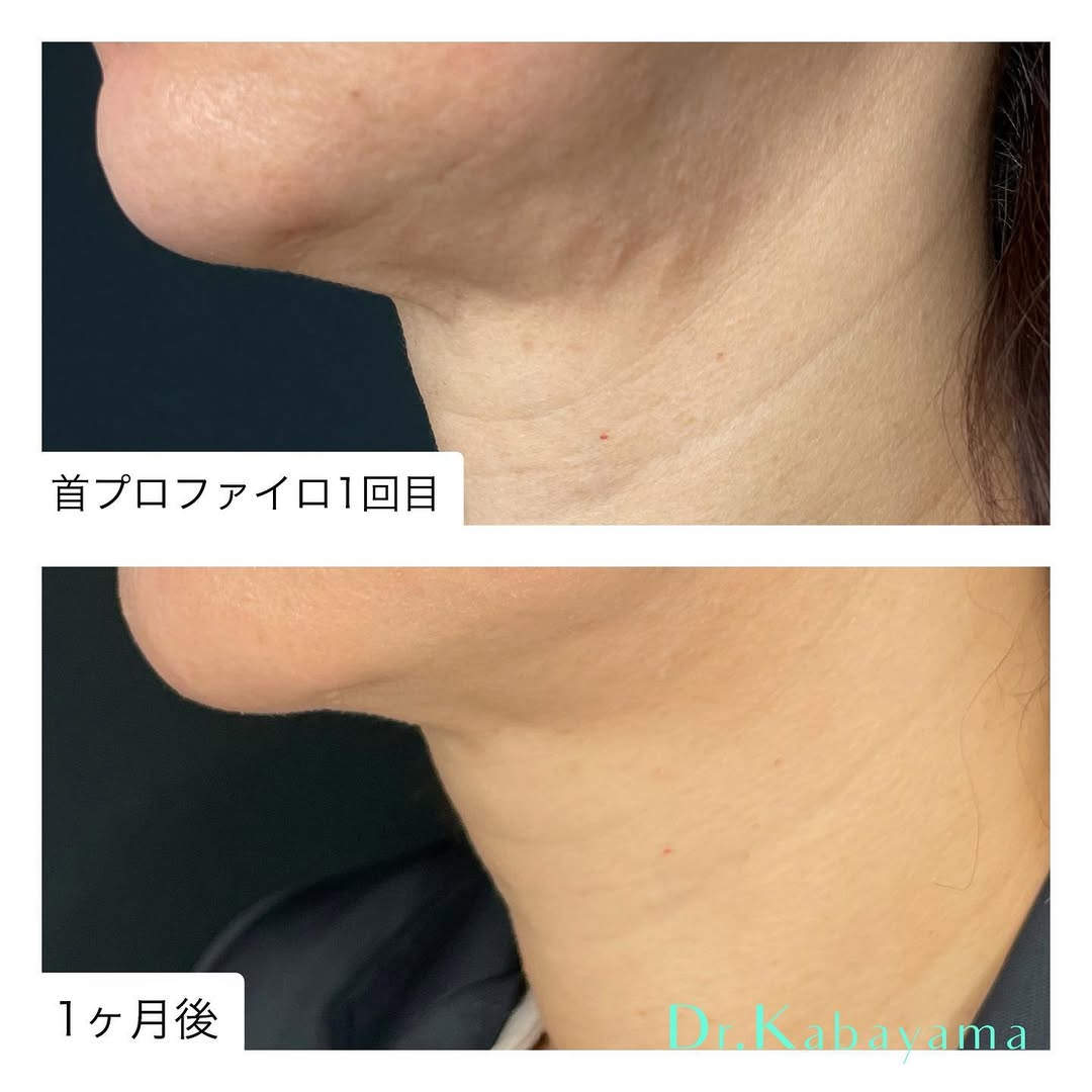 プロファイロ（ヒアルロン酸）