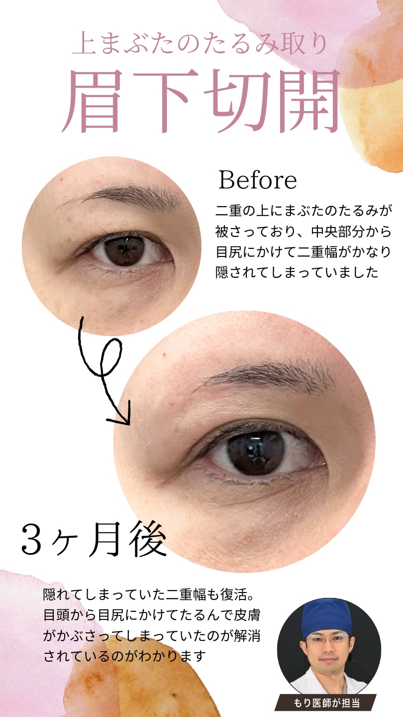瞼の構造を医学的に熟知している医学博士による症例