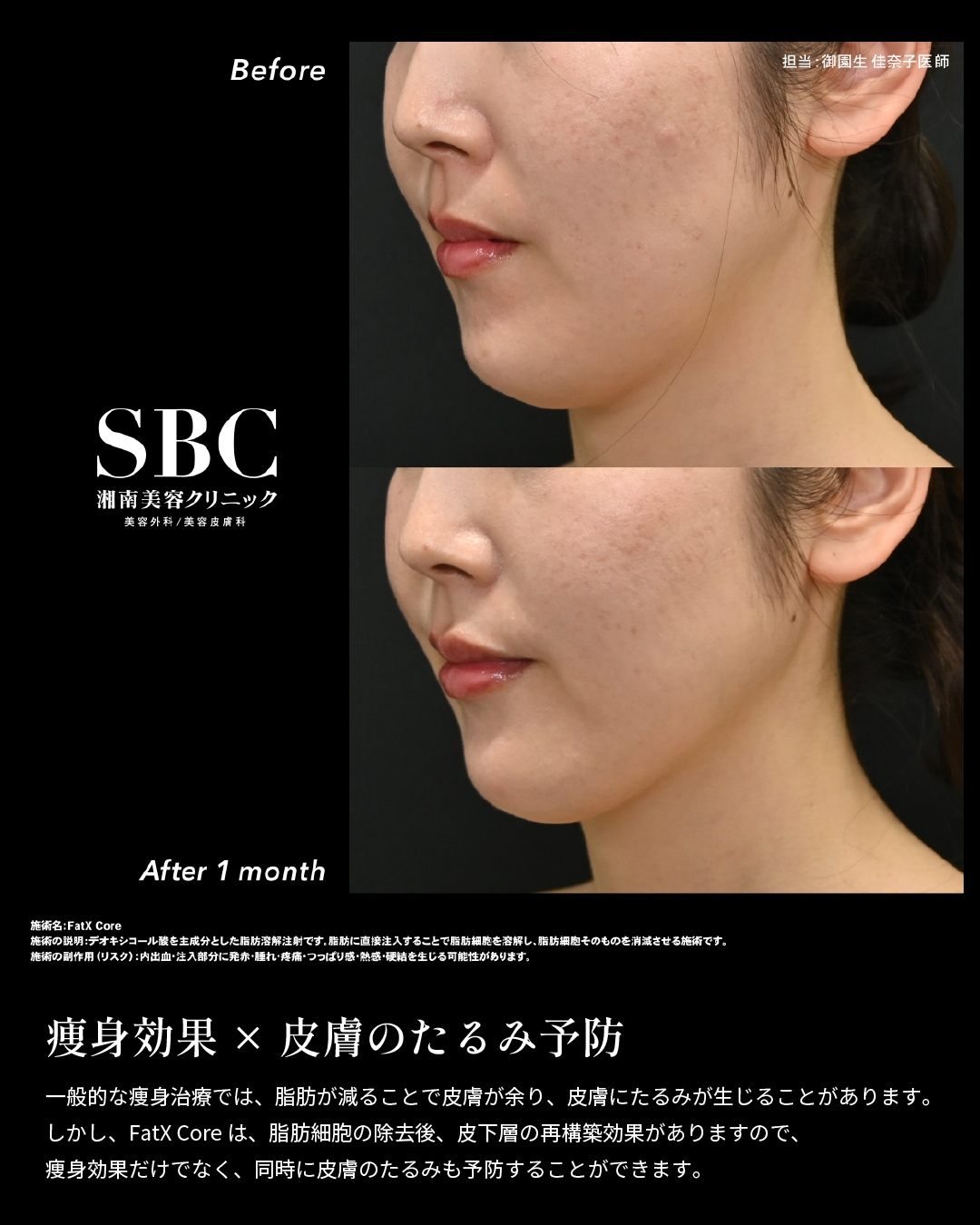 お顔の症例ですが、対応部位であればご希望の箇所に注入可能✨
