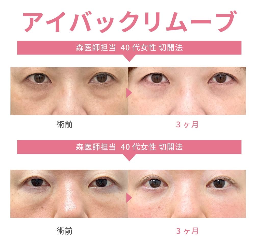 アイバックリムーブ法(執刀数No.2獲得済み👑)