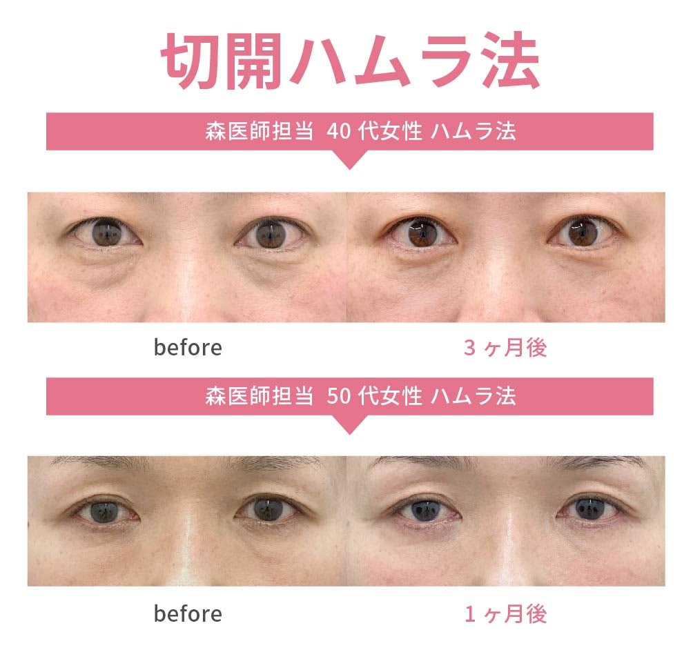 切開ハムラ(執刀数No.2獲得済み)