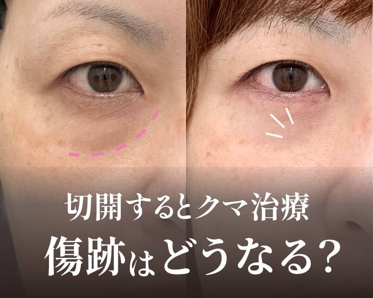 切開ハムラ法・切開法クマ取りの傷跡は綺麗になるのか？ダウンタイムを元に解説し、あなたの不安を解消します！