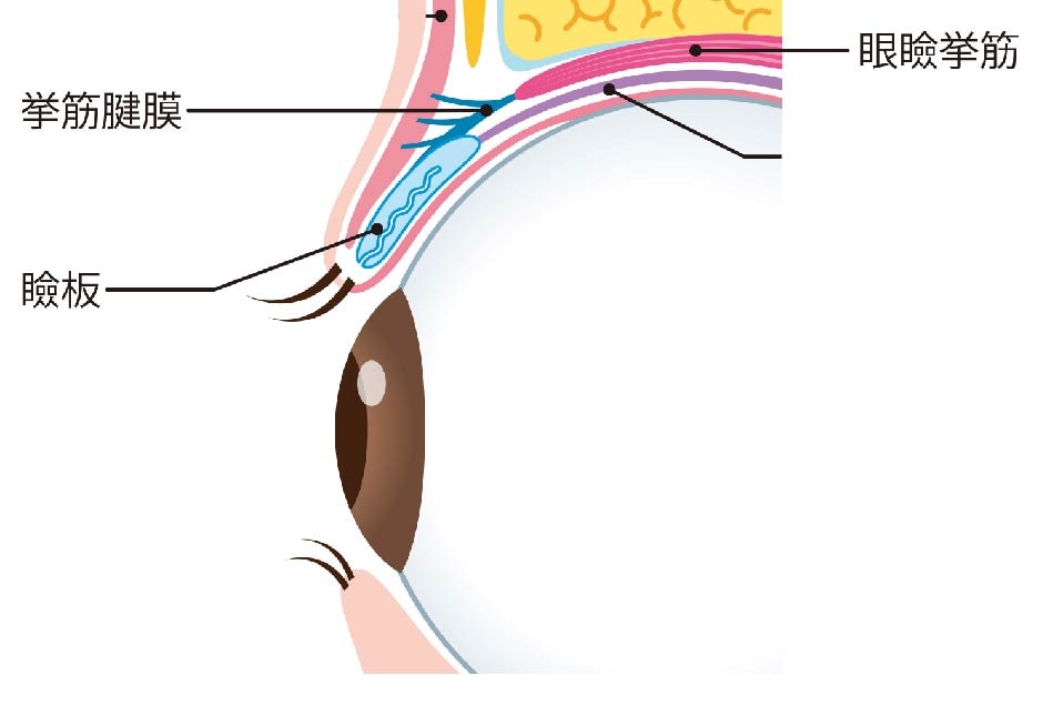 眼瞼下垂の手術では”挙筋短縮術”という術式を行います