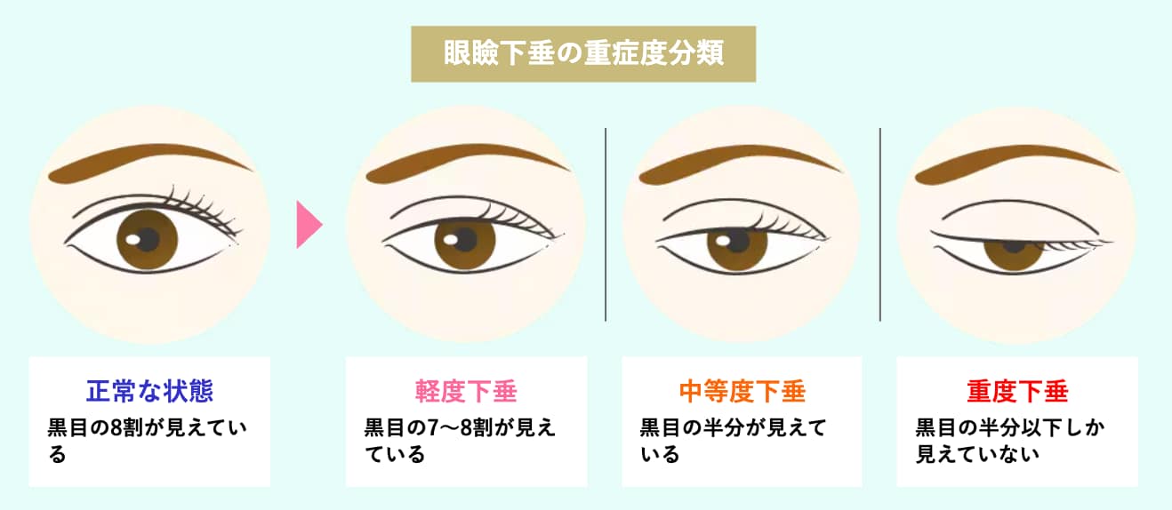 眼瞼下垂の症状には個人差がございます