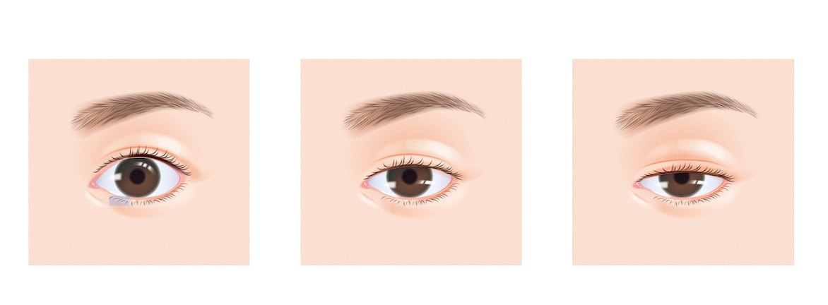 主な症状③目力のない目になる