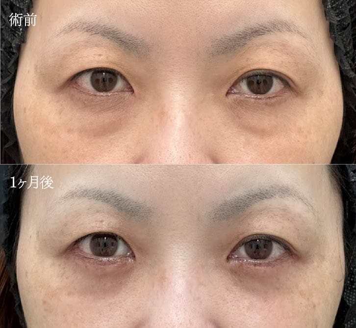 切開が不安な方は、形成外科専門医に任せましょう✨