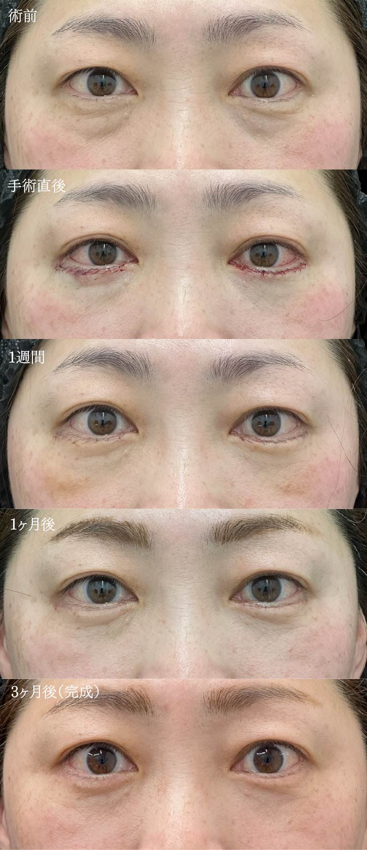 ダウンタイム紹介②