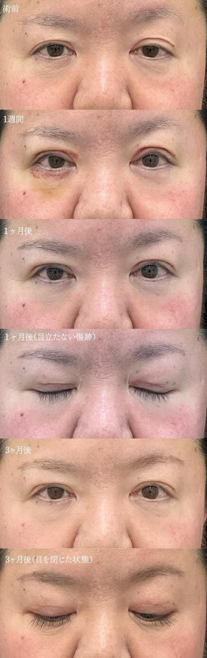 実際に森🌳院長が担当した眼瞼下垂のお客様