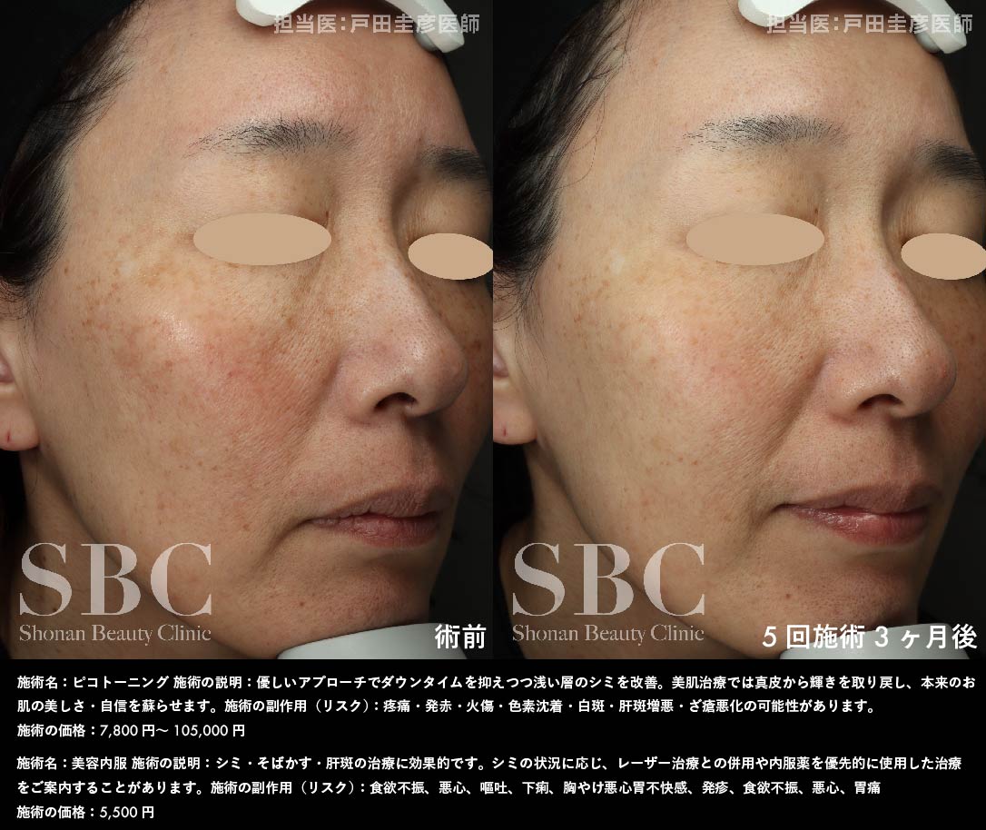 ピコトーニング・美容内服×5回施術を受けたお客様