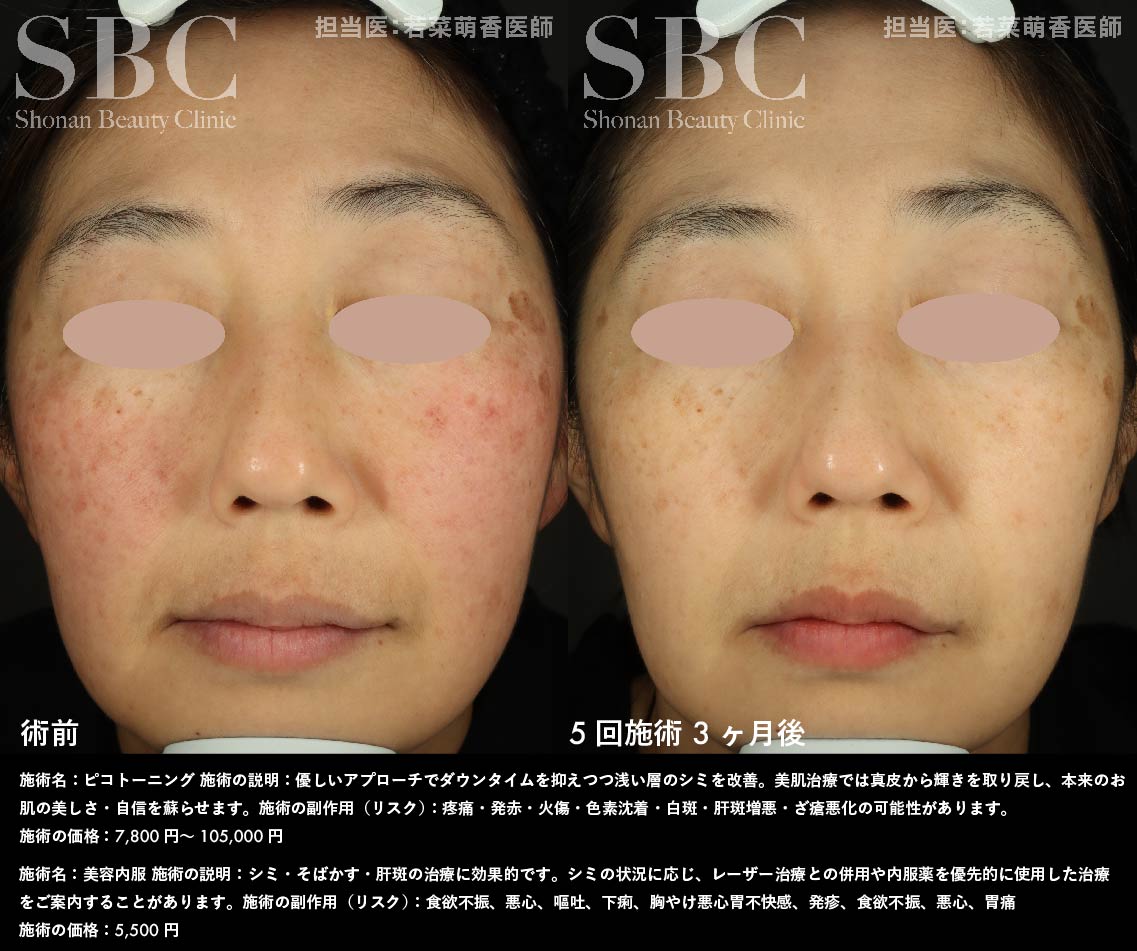 ピコトーニング・美容内服×5回施術を受けたお客様