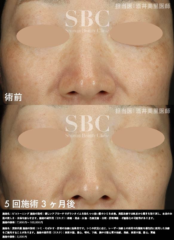 ピコトーニング・美容内服×5回施術を受けたお客様