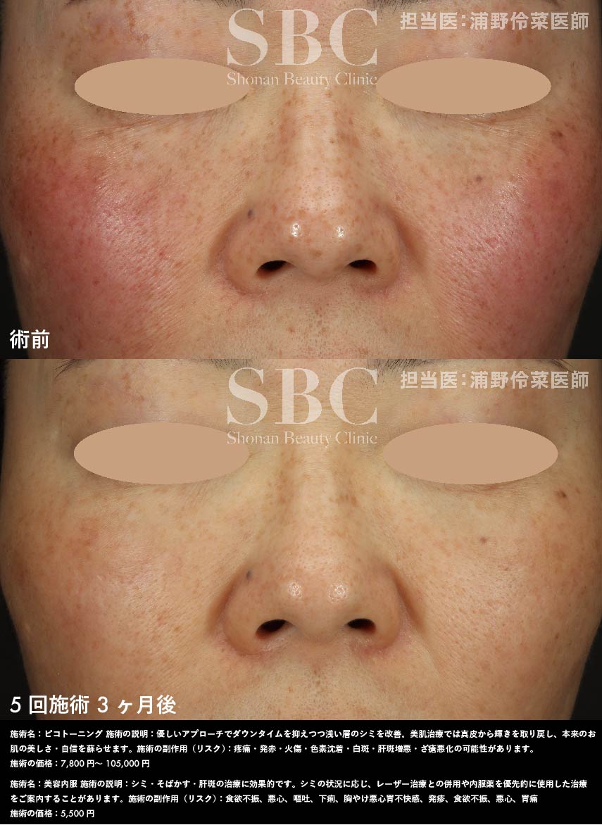 ピコトーニング・美容内服×5回施術を受けたお客様