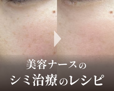 【5分でわかる】肝斑あるけどシミ取りしたい❗️福山院スタッフが実際に受けているシミ取りレシピ🗓️