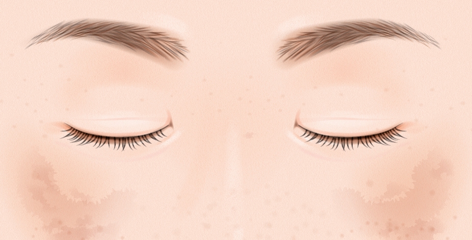 肝斑があるとシミ取りレーザーはできないの？