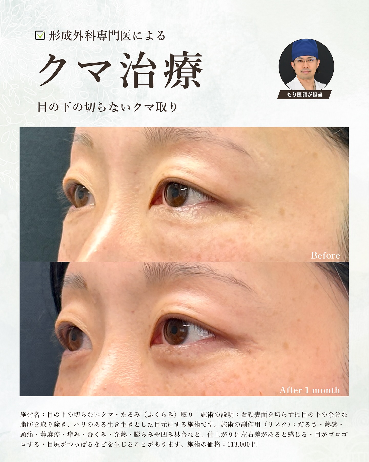 目元整形エキスパートDrが執刀するクマ治療