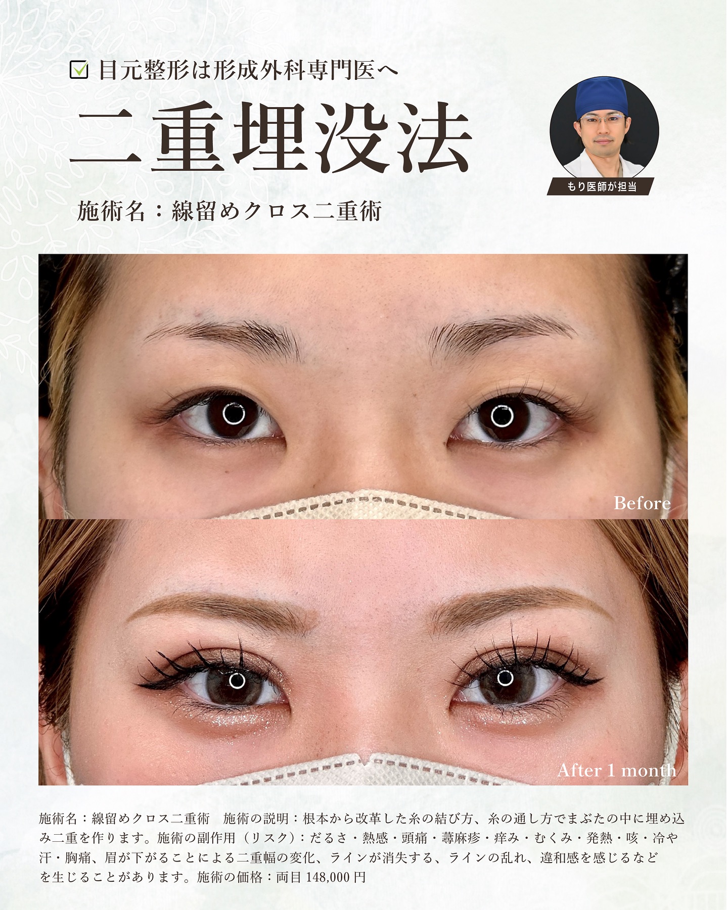 3期連続執刀数No.1医師が担当する埋没法♪