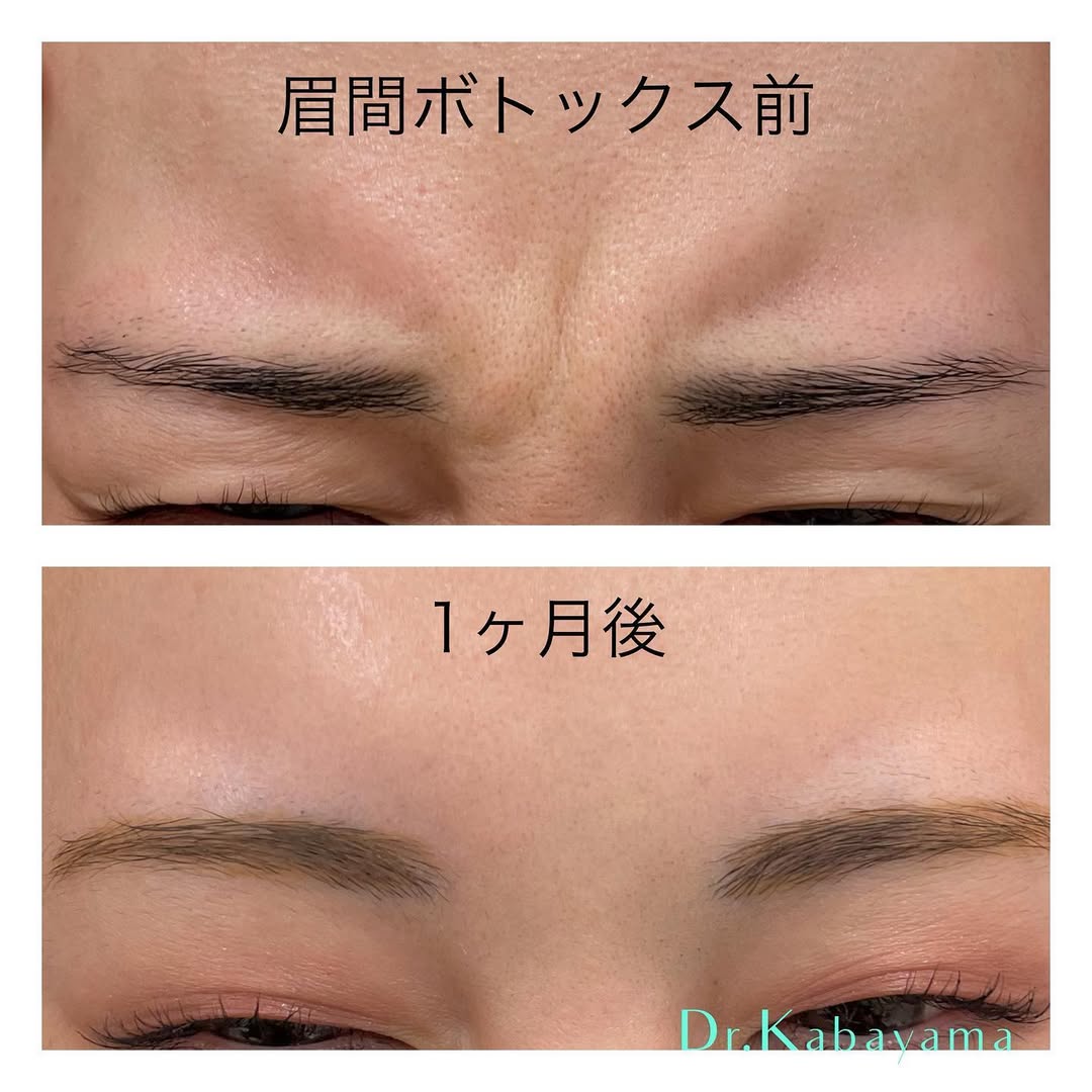 皮膚科技術指導医によるボトックスによるシワ改善✨