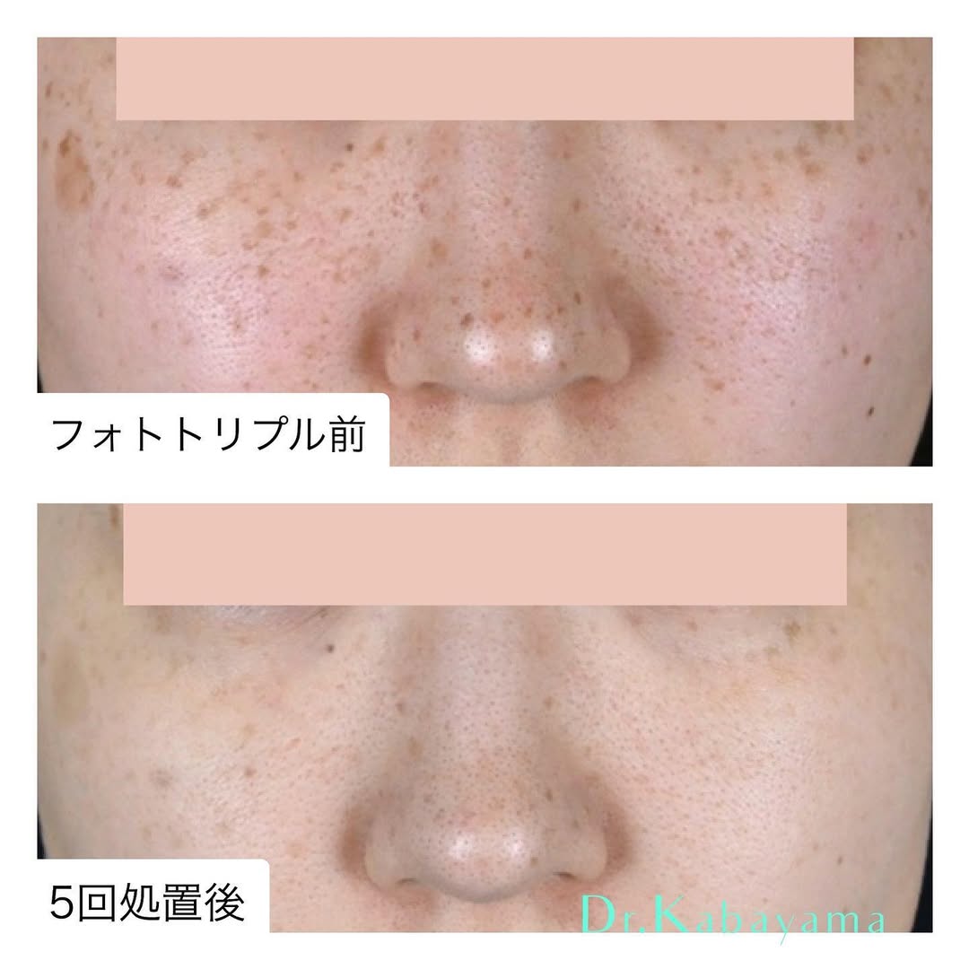 フォトダブル・フォトトリプル