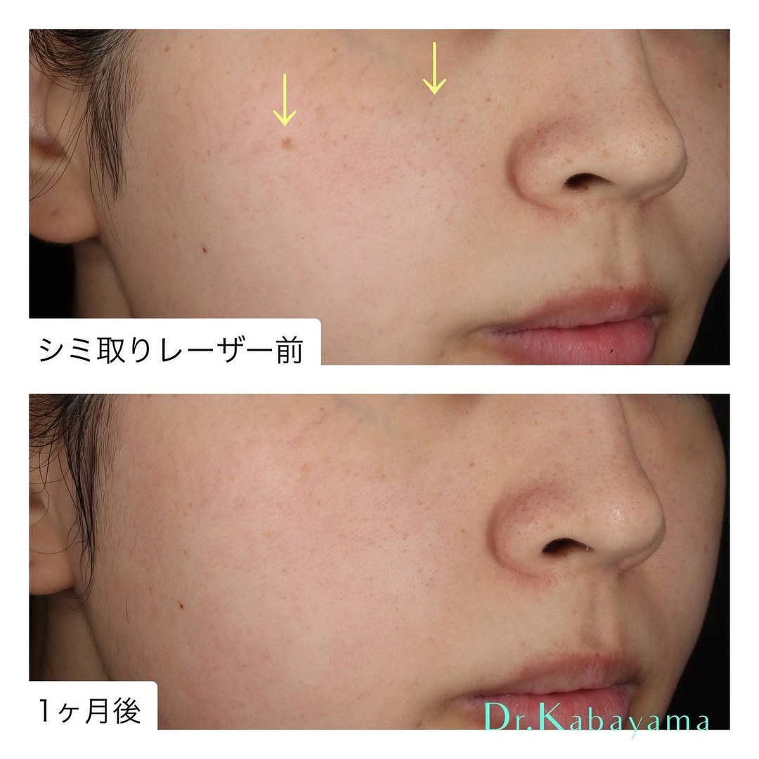 シミ取りレーザー