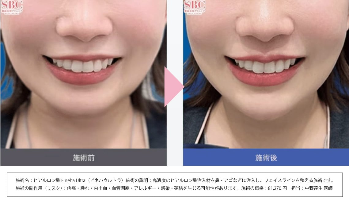 顎に注入した症例写真の紹介