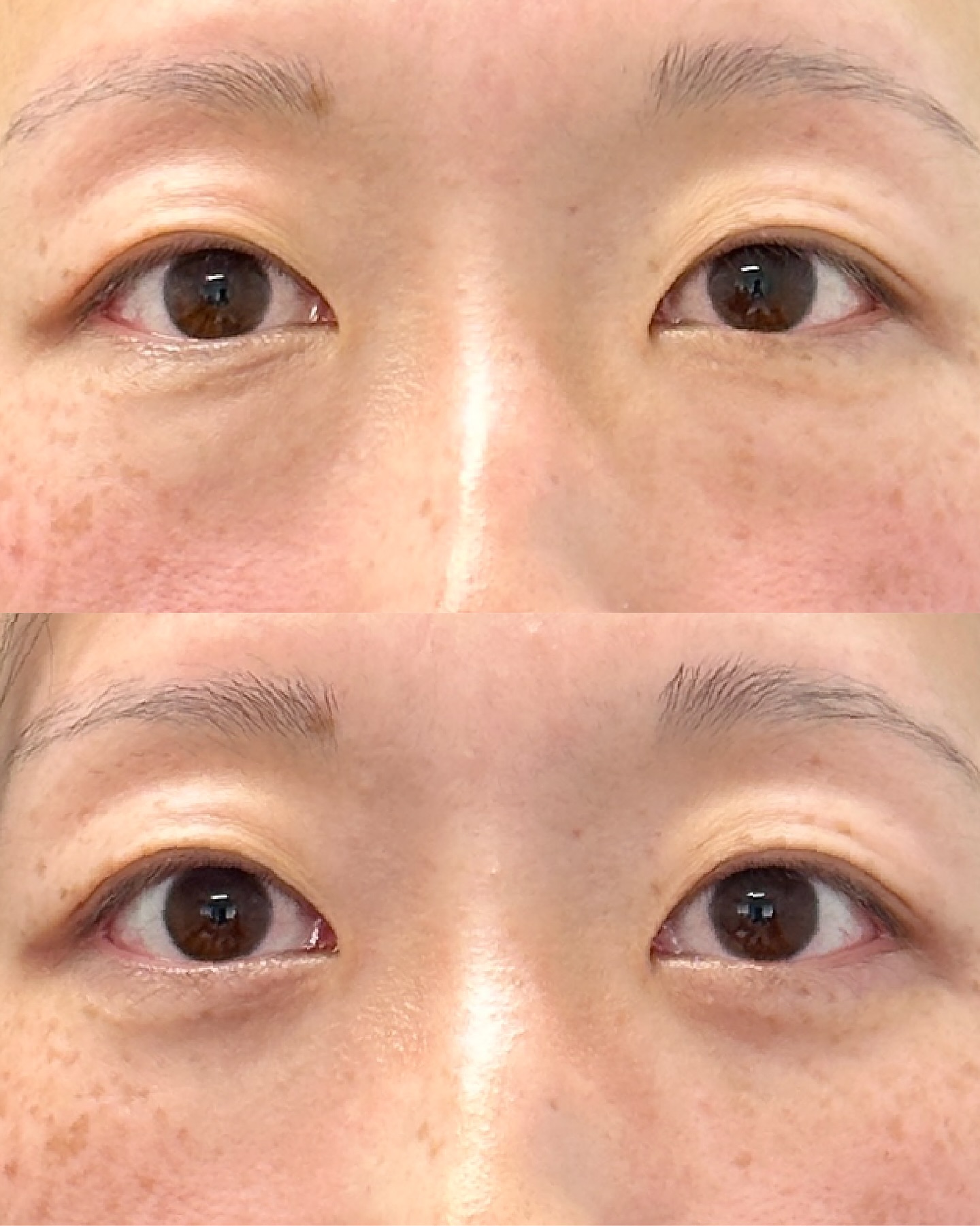 【脱脂法】施術名：目の下の切らないクマ取りのみを受けられた方