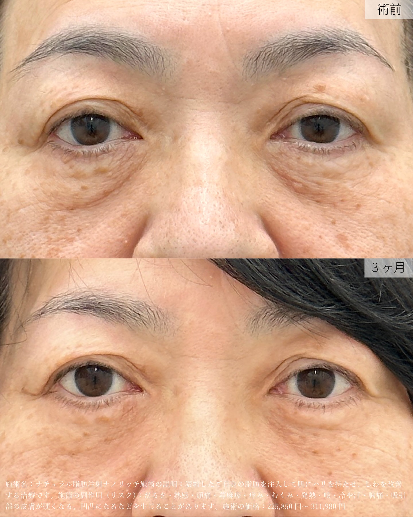 【切開ハムラ法】