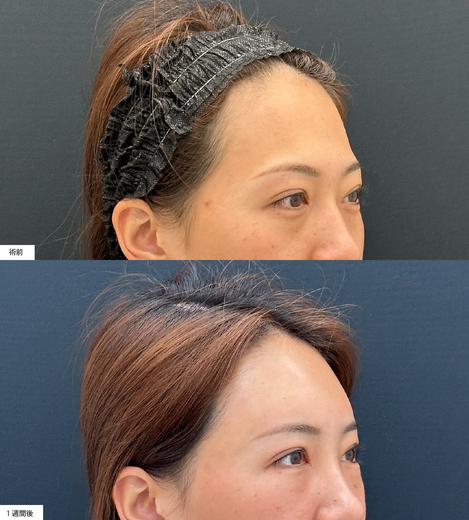 コンデンスリッチ脂肪注入