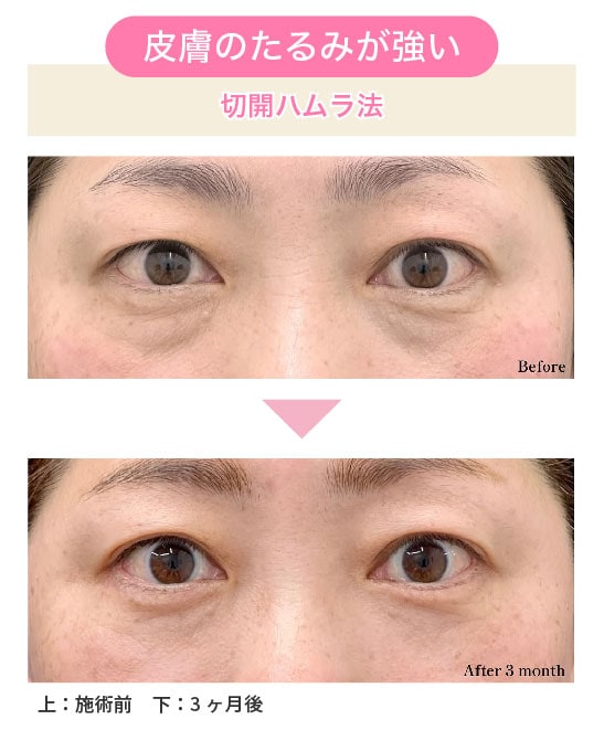 皮膚の余り・たるみが強い方へ【切開ハムラ法】<br />
