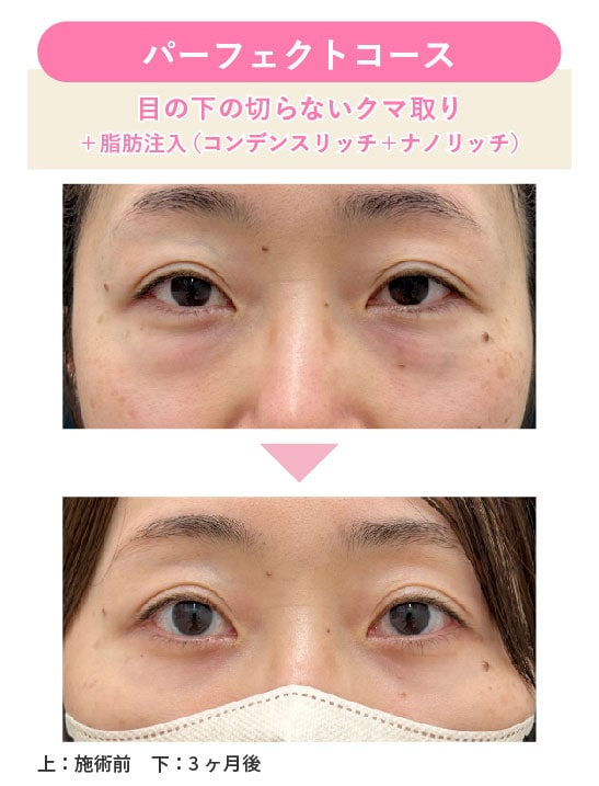徹底改善：パーフェクトコース