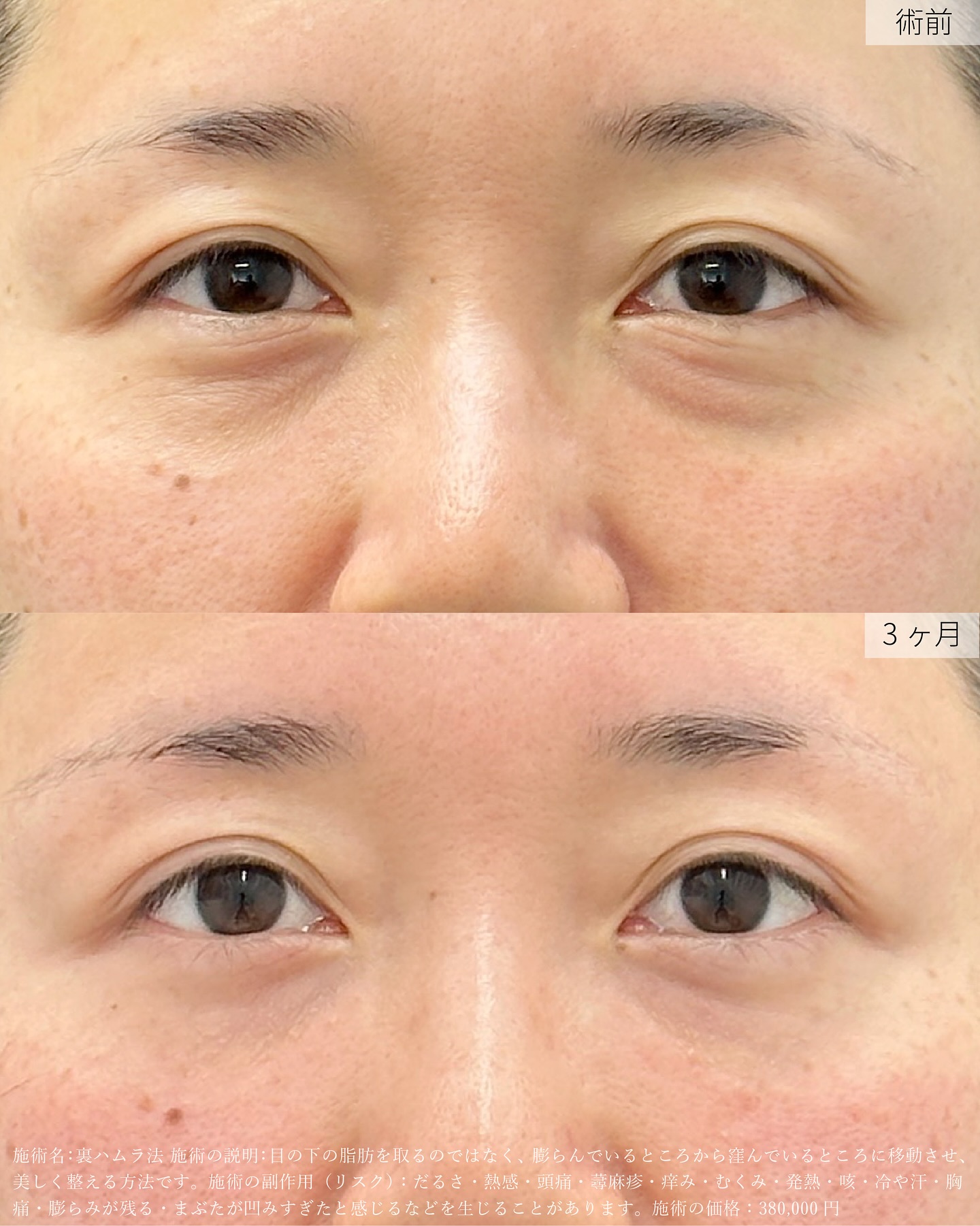 【裏ハムラ法】