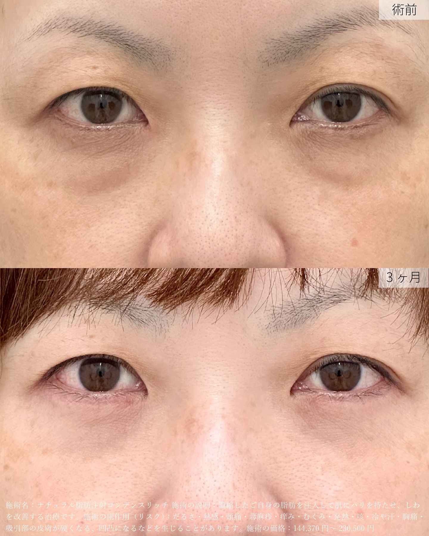 【アイバックリムーブ法】