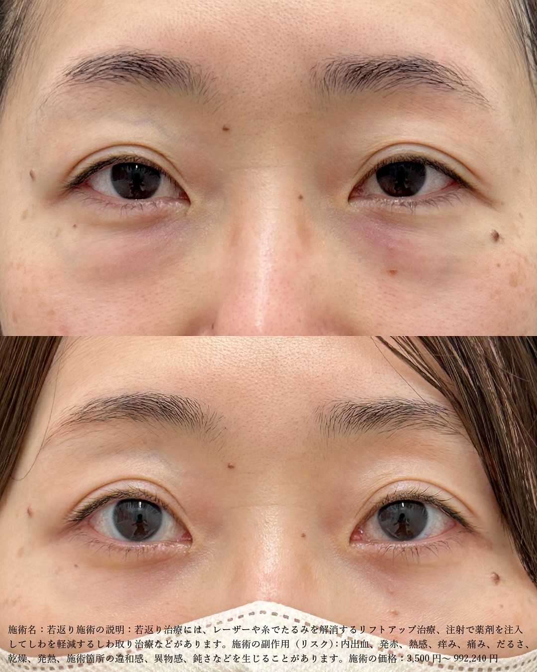 【ナノリッチ脂肪注入】