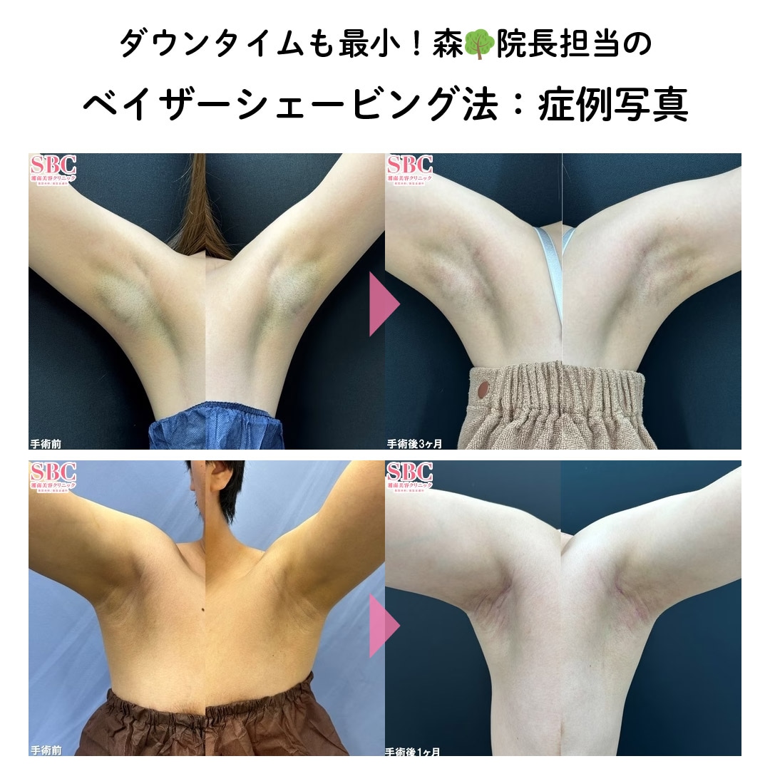 ②根こそぎベイザーシェービング<br />
