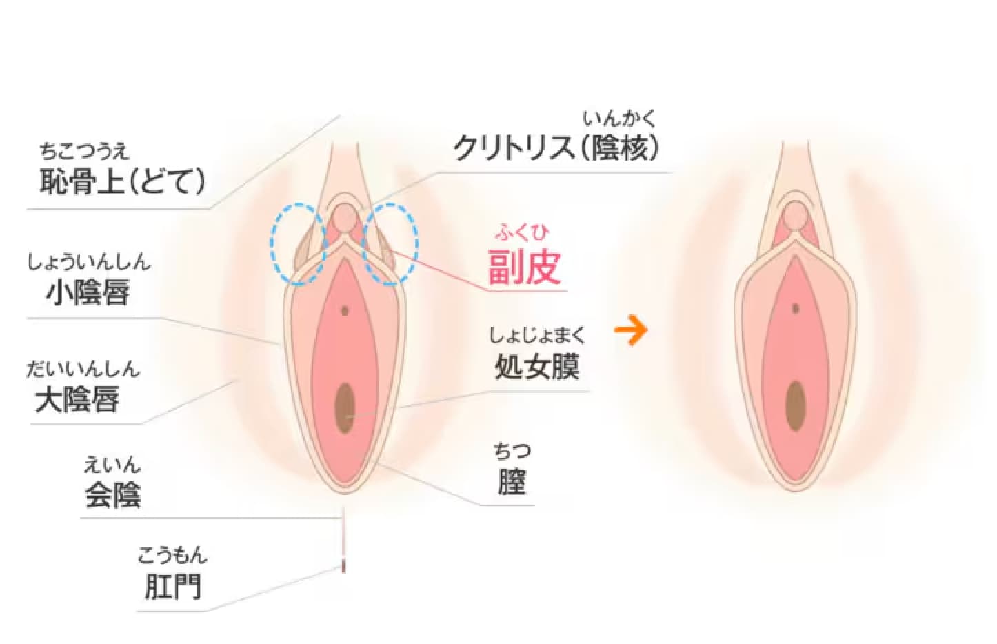 副皮除去術