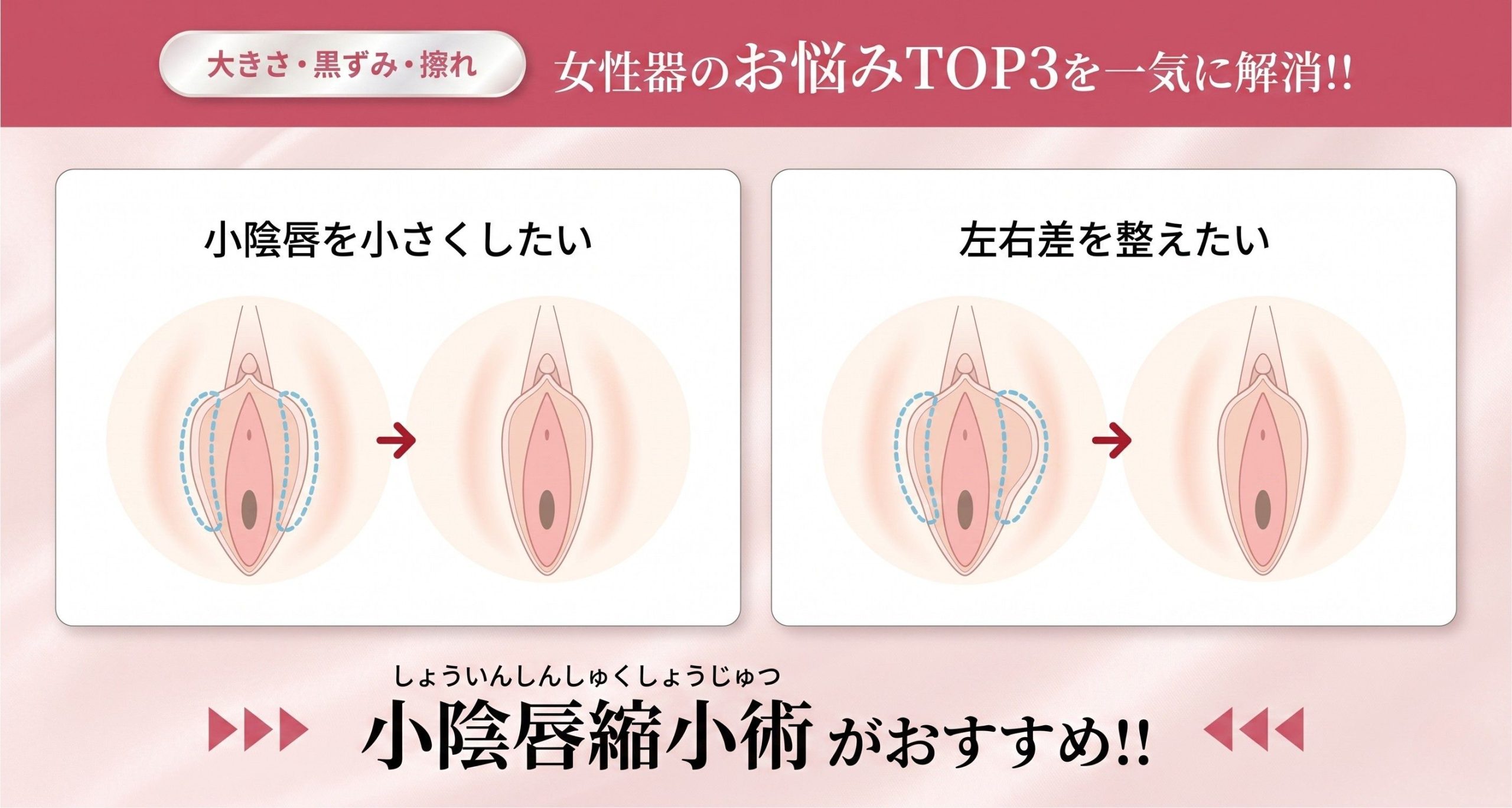 小陰唇の大きさ・黒ずみ・擦れをまとめて解決！デリケートゾーンの3大お悩みを一度に解消へ