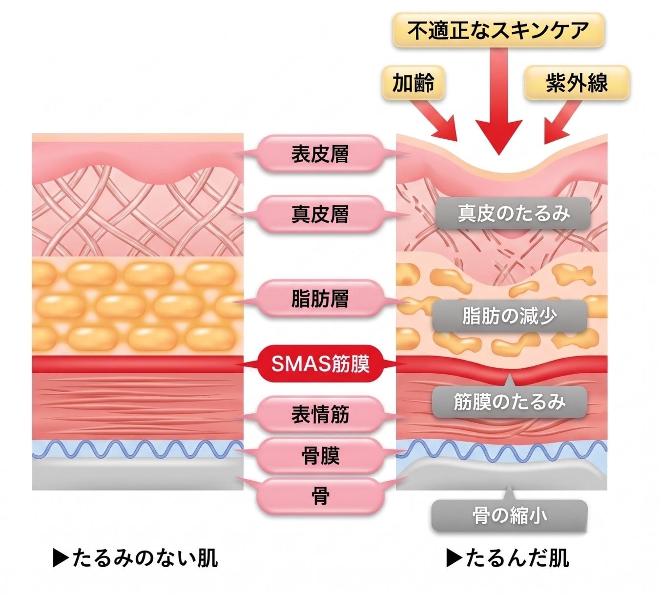 たるみの原因