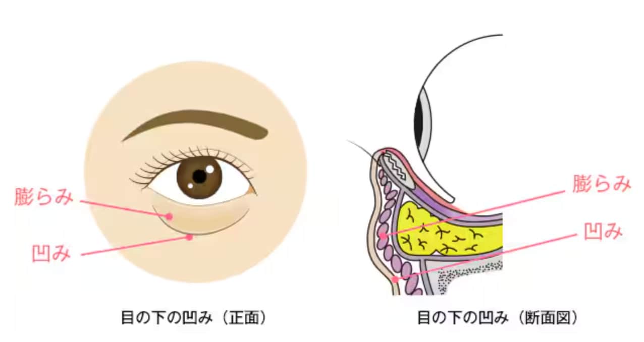 ②目の下に「膨らみ」と「凹み」の両方がある