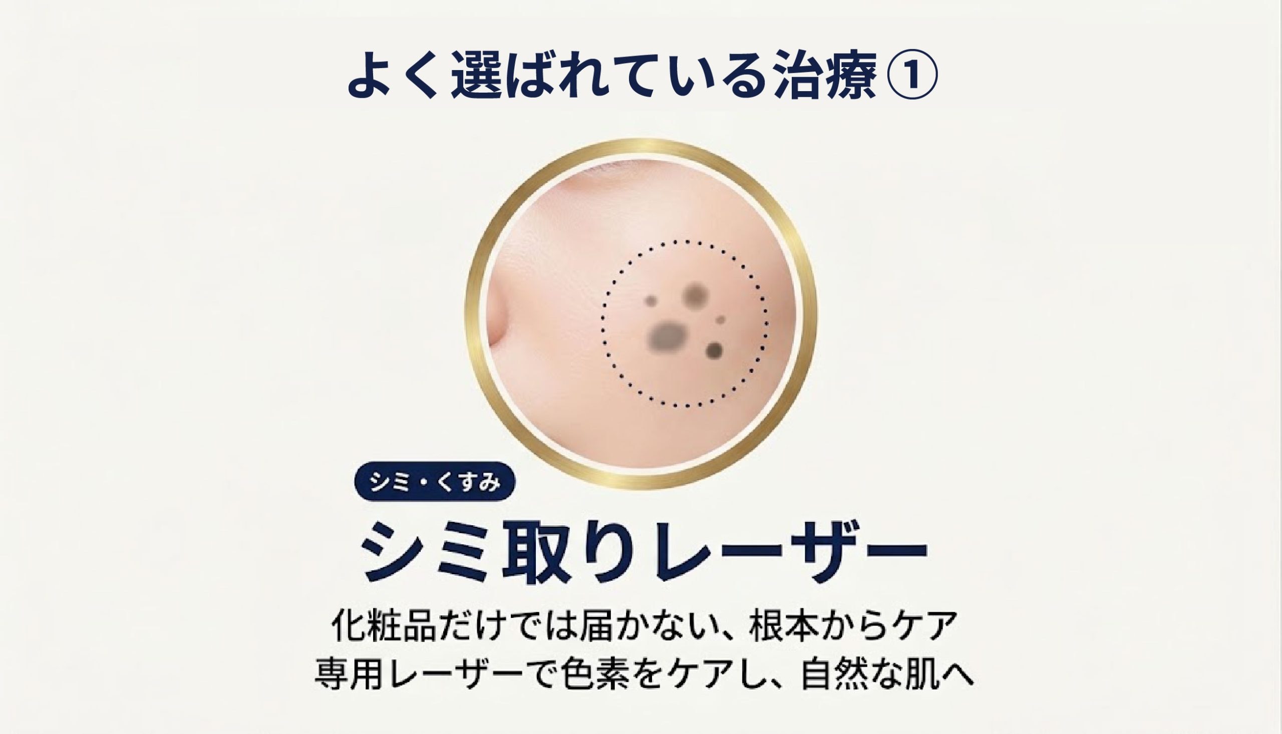 シミがピンポイントで気になってきたら「シミ取りレーザー」