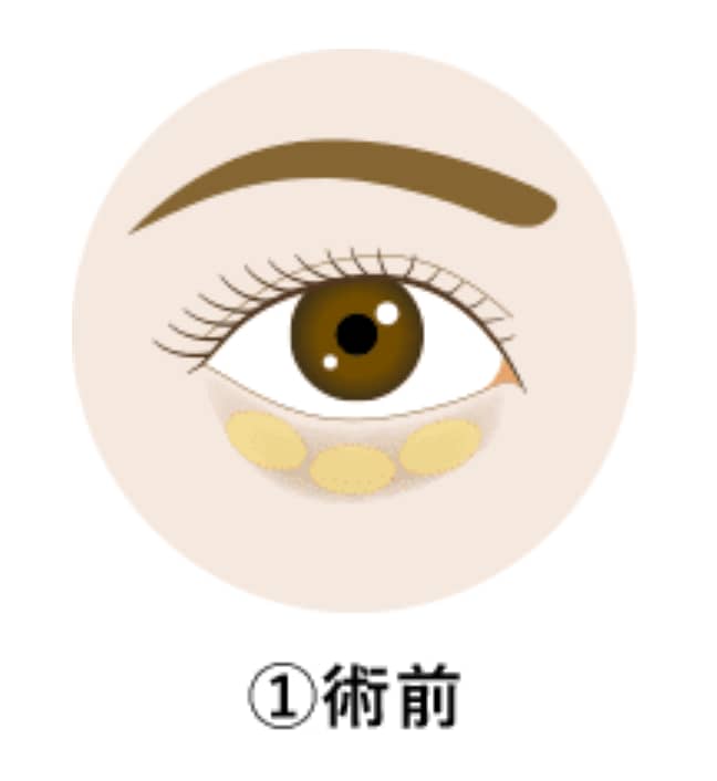 施術の流れ：その①