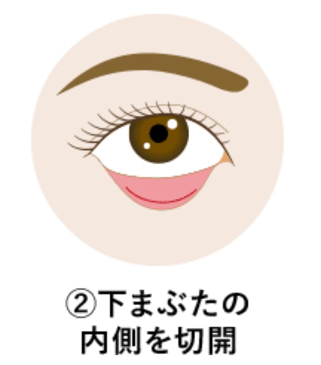施術の流れ：その②