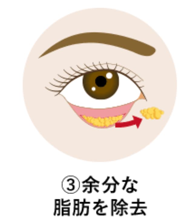 施術の流れ：その③
